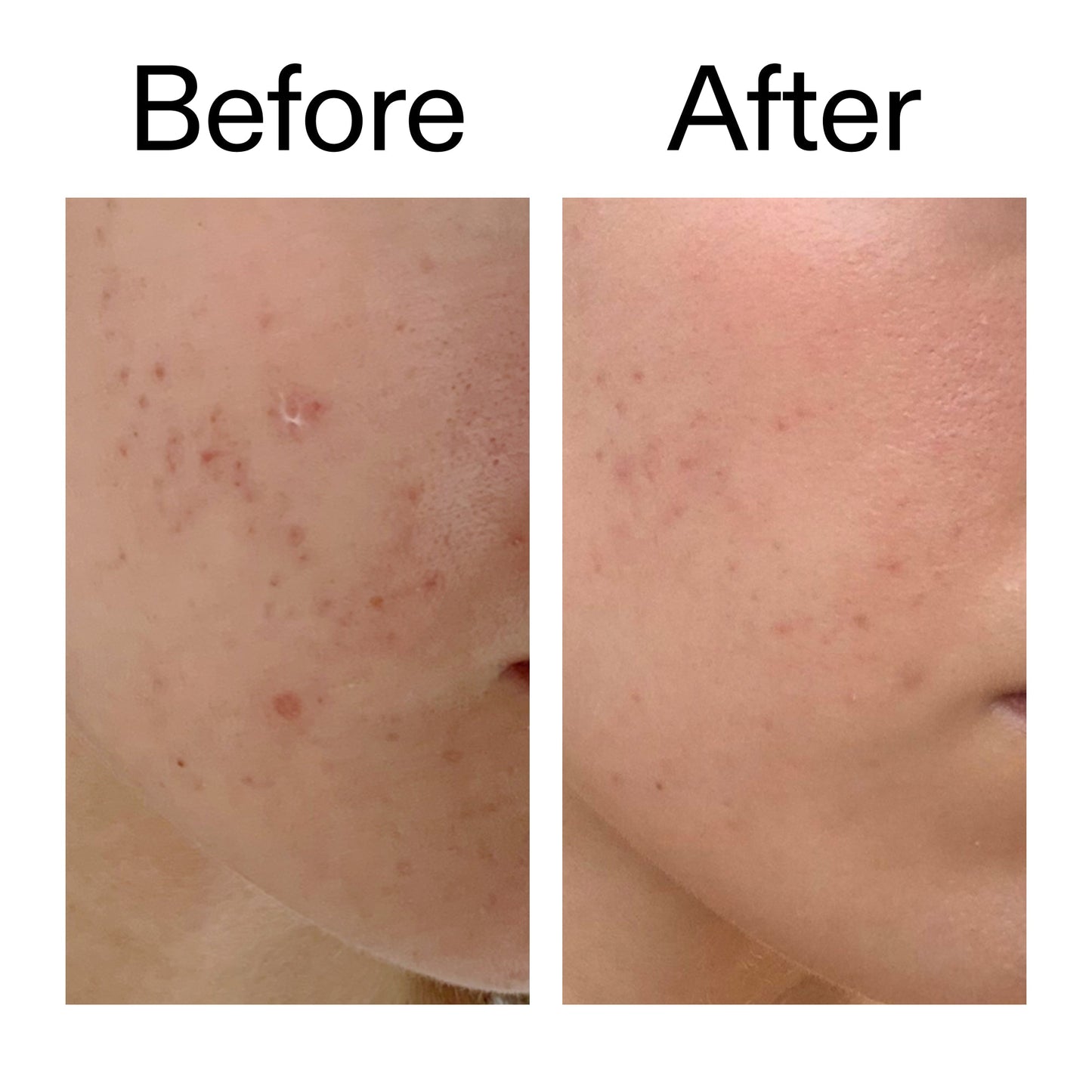 mandelic-acid-treatment-c3 Mandelic_Acid_Treatment_Before_After_2000x2000_4885ac6e-c5d7-4279-a72a-1417af7dce35.jpg