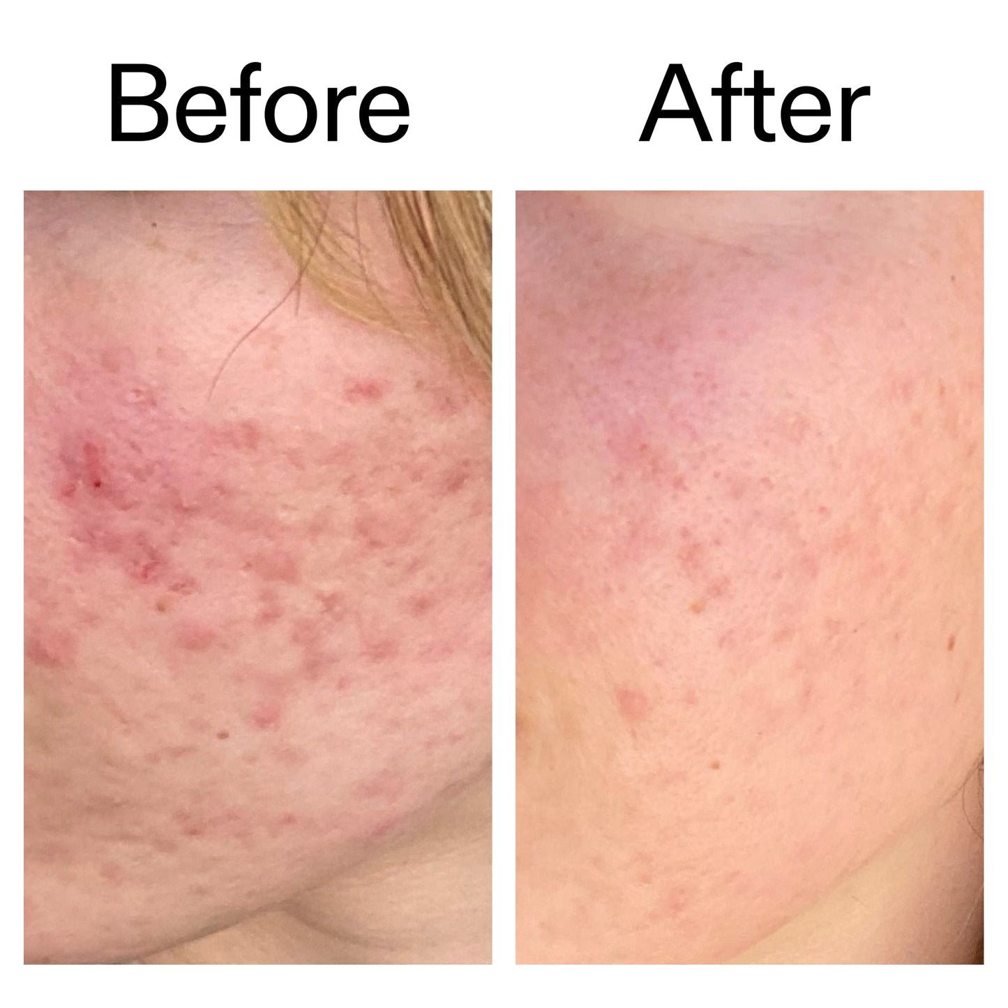 10-azelaic-acid-serum-for-redness-relief-j1 Azealic_Acid_Serum_B_A_Ppage_2000_x_2000.jpg