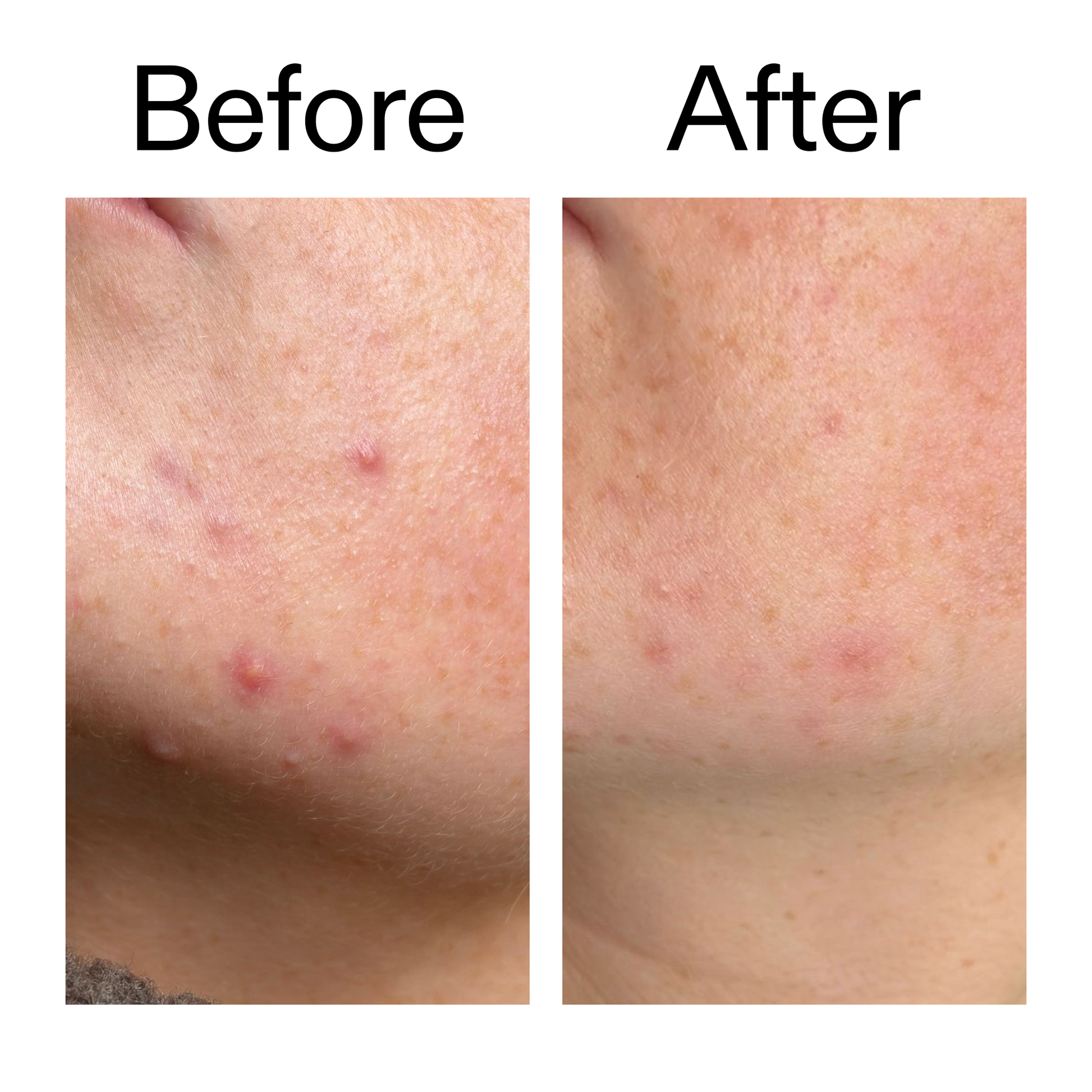 10-azelaic-acid-serum-for-redness-relief-j1 B_A_1_PPAGE.png