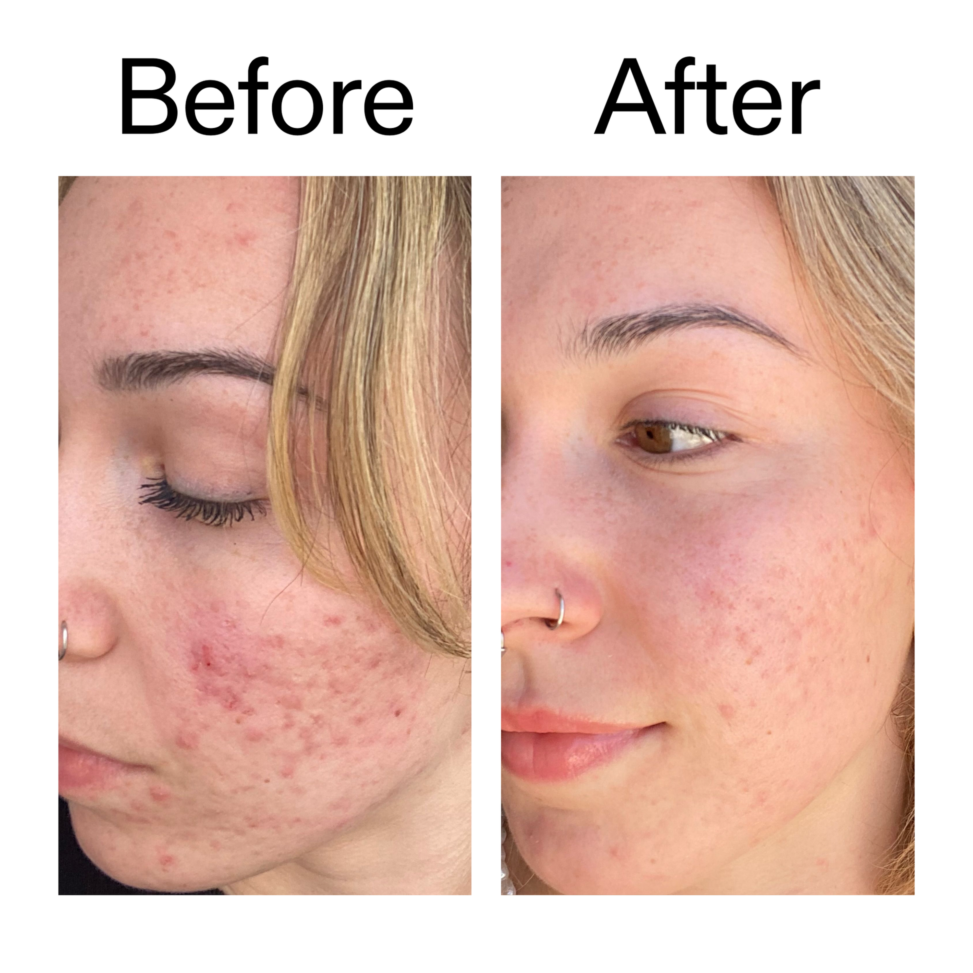 10-azelaic-acid-serum-for-redness-relief-j1 B_A_2_PPAGE.png