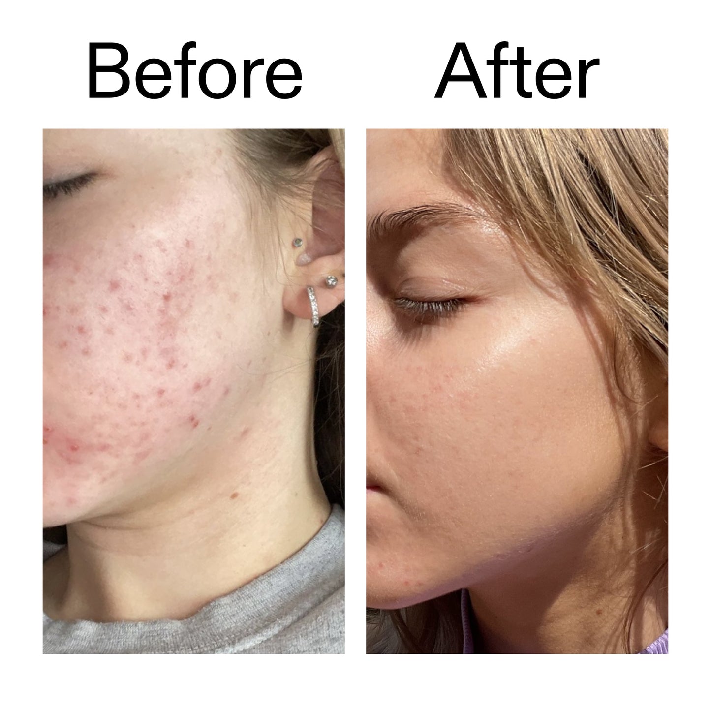 beta-hydroxy-acid-bha-serum-o8 Beta_Hydroxy_Acid_Serum_Before_After_2000x2000_96fda3e5-938d-49ef-bcf2-a0fa6ece4e2c.jpg