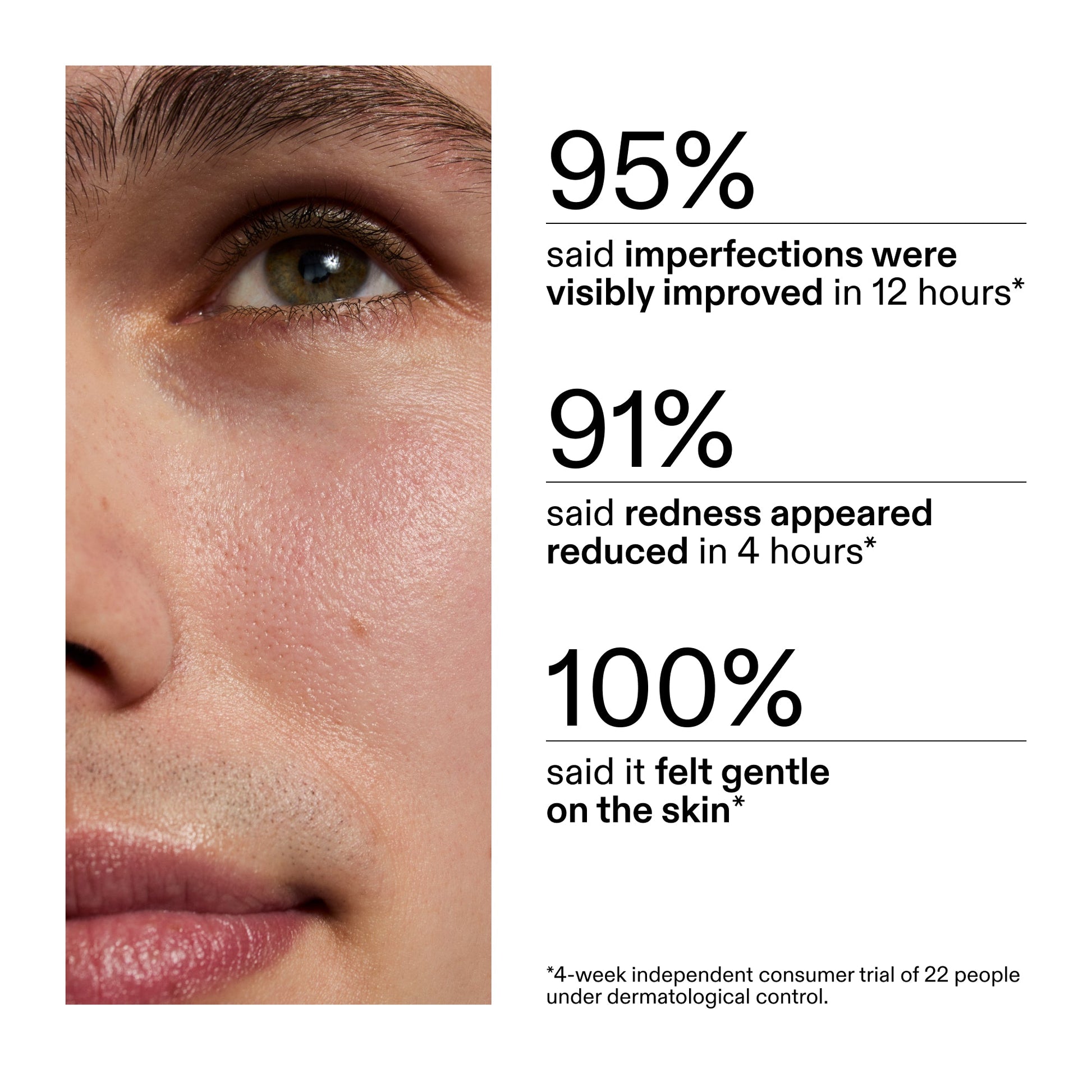 succinic-acid-acne-treatment-d0 CA_Succinic_Acid_Treatment_key_Claims_2000x2000_db91b0f1-7f29-4bfe-bb16-63a47f500960.jpg