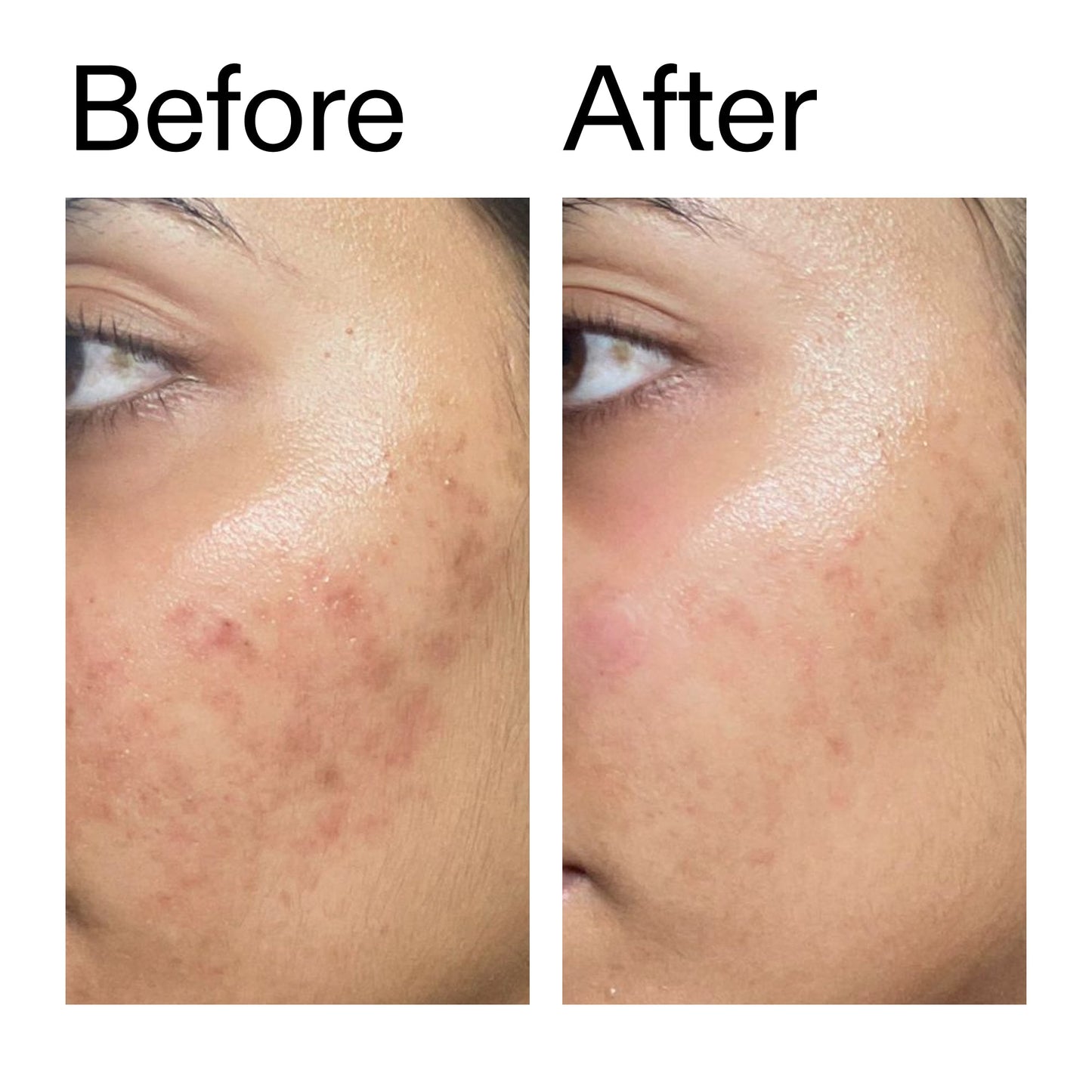 ectoin-hydro-barrier-serum-duo-n8 Ectoin_Hydro-barrier_Serum__Before_After_2000x2000_34261920-d004-48d0-9c7b-8e1c15971bfd.jpg