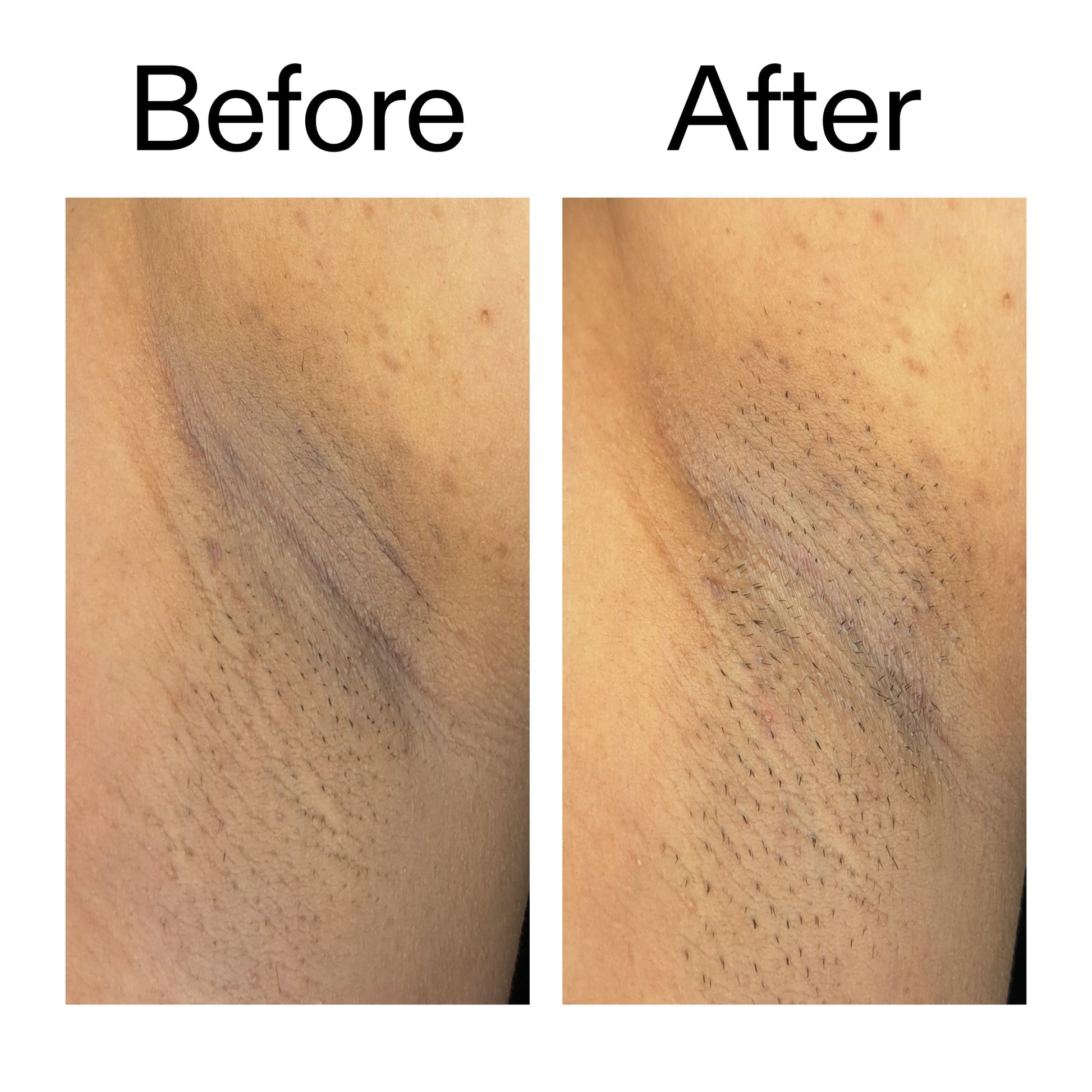 glycolic-acid-exfoliating-body-stick-duo-q1 Glycolic_Acid_Exfoliating_Body_Stick_Before_After_V3_2000x2000_ea919cd9-1439-4a46-82a0-76200eb5bb42.jpg