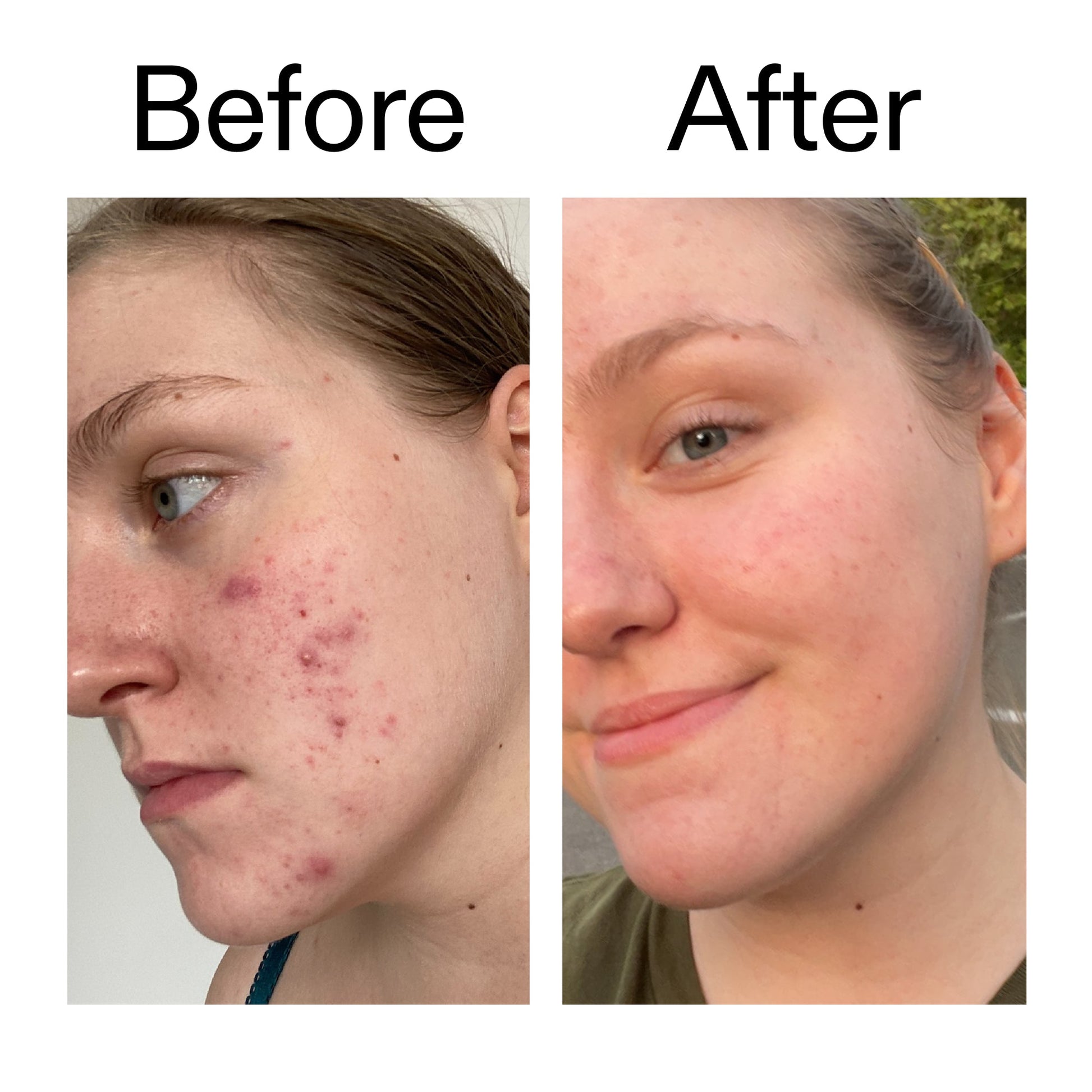 glycolic-acid-toner-s8 Glycolic_Acid_Toner_Before_After_2000x2000_49f0b9f7-e71b-4b2e-a8f8-2ea4b73247bb.jpg