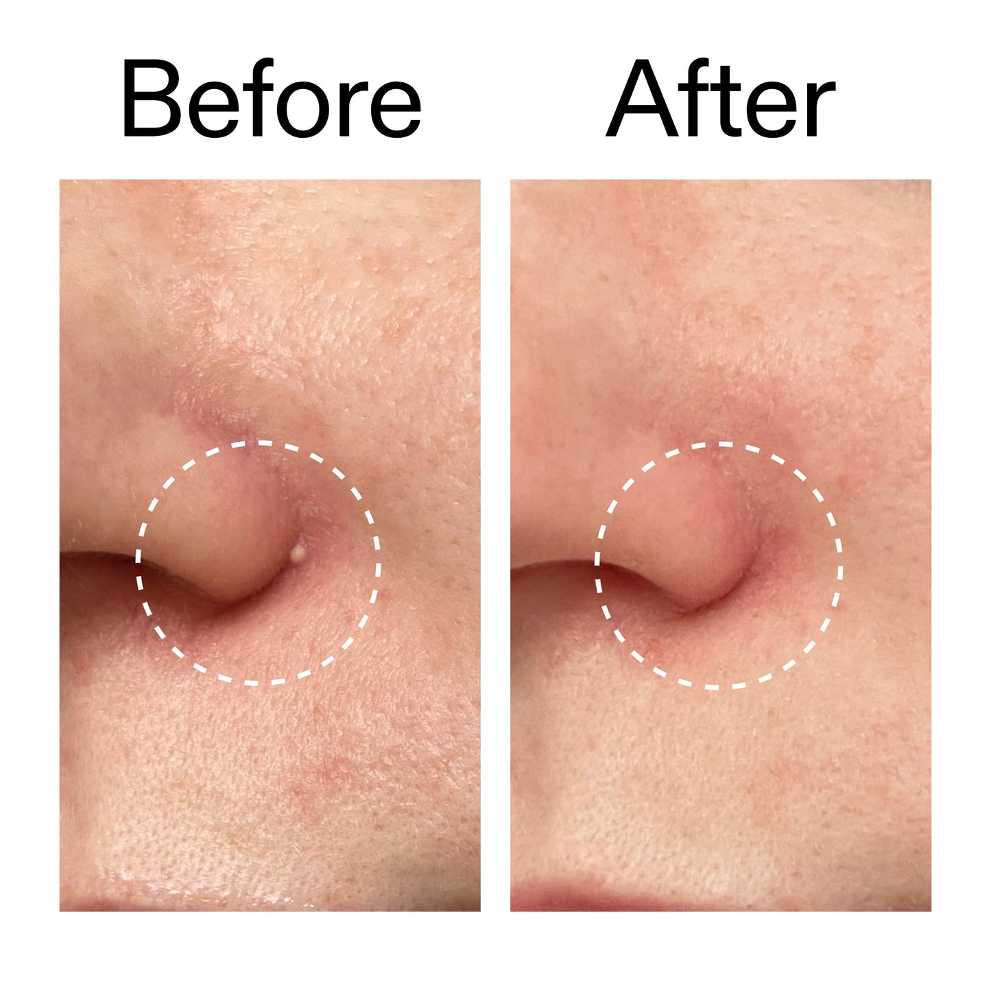 hydrocolloid-invisible-pimple-patches-pack-of-22-b2 Hydrocolloid_Invisible_Pimple_Patches_Before_After_2000x2000_b02aa37b-c78a-4682-91de-9135af5bb7df.jpg