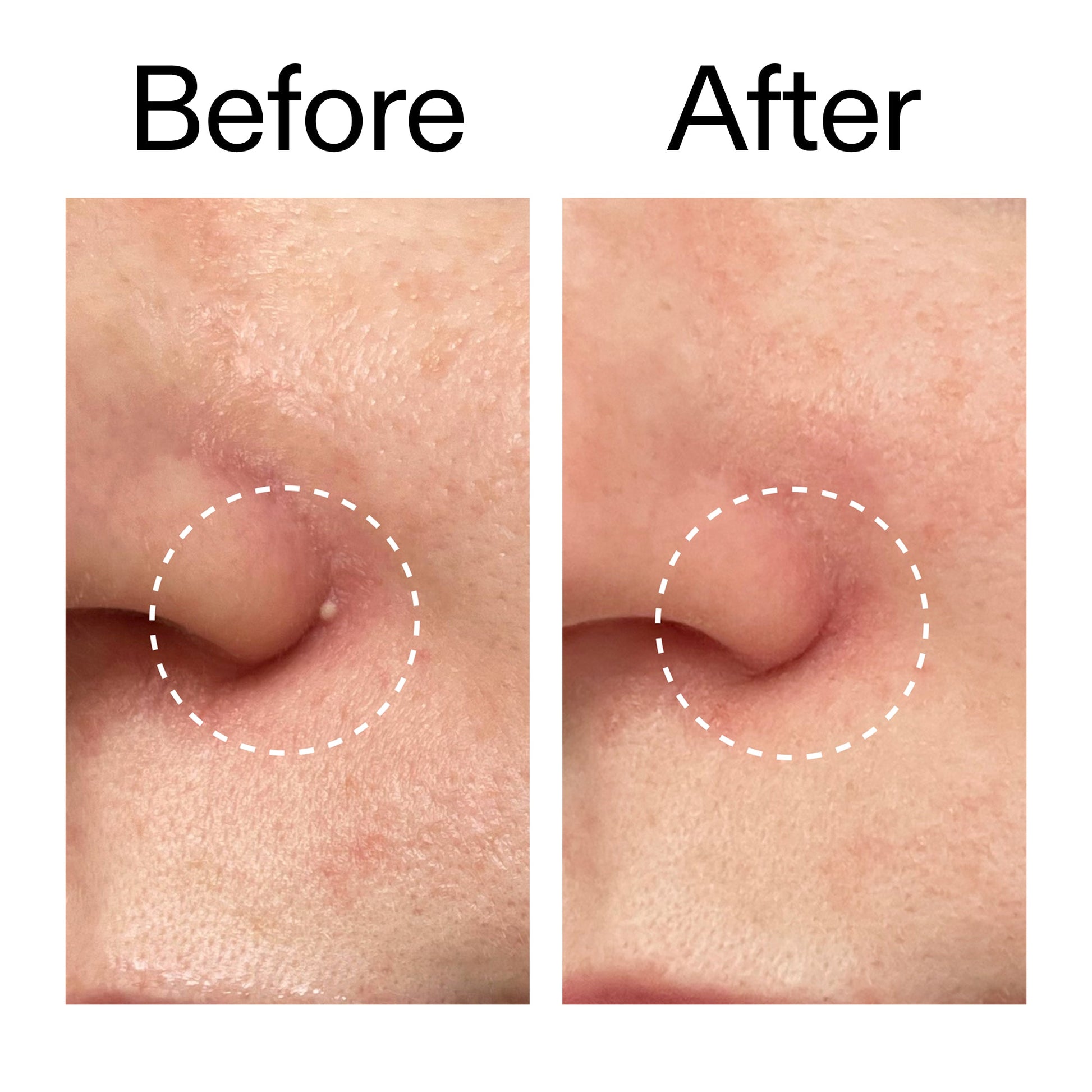 hydrocolloid-invisible-pimple-patches-pack-of-22-b2 Hydrocolloid_Invisible_Pimple_Patches_Before_After_2000x2000_b02aa37b-c78a-4682-91de-9135af5bb7df.jpg