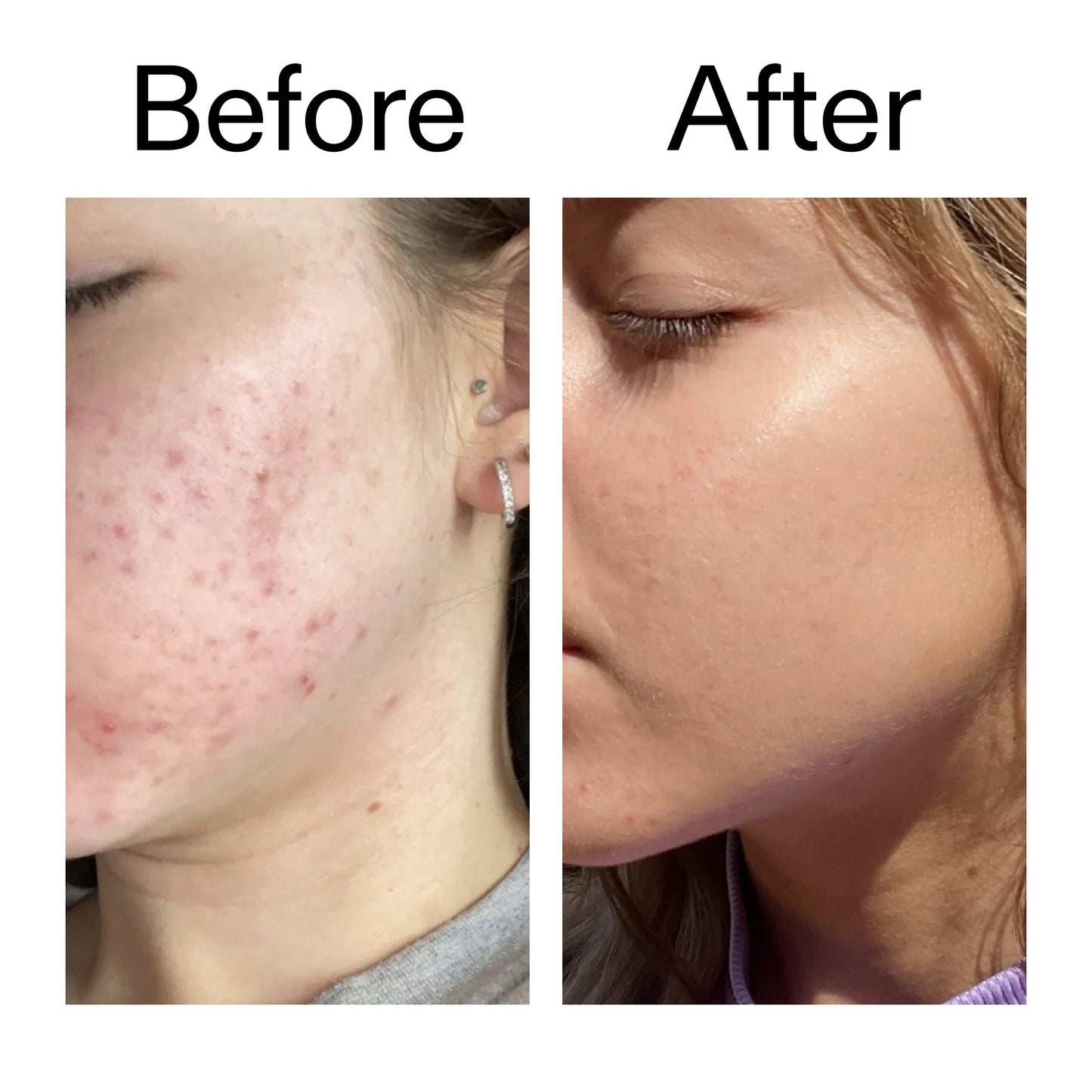 10-niacinamide-serum-u3 Niacinamide_Serum_Before_After_2000x2000_bde32455-9e7d-448e-b053-bef41504f0a9.jpg