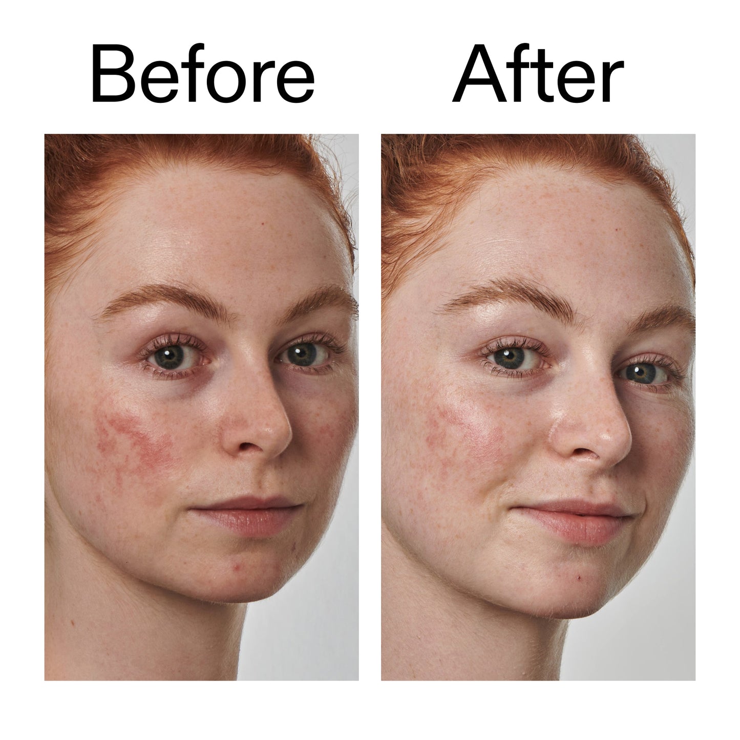10-azelaic-acid-serum-for-redness-relief-j1 Redness_Relief_Serum_Before_After_2000x2000_3334dc9a-cce9-4e00-8aec-7ad89ca051f2.jpg