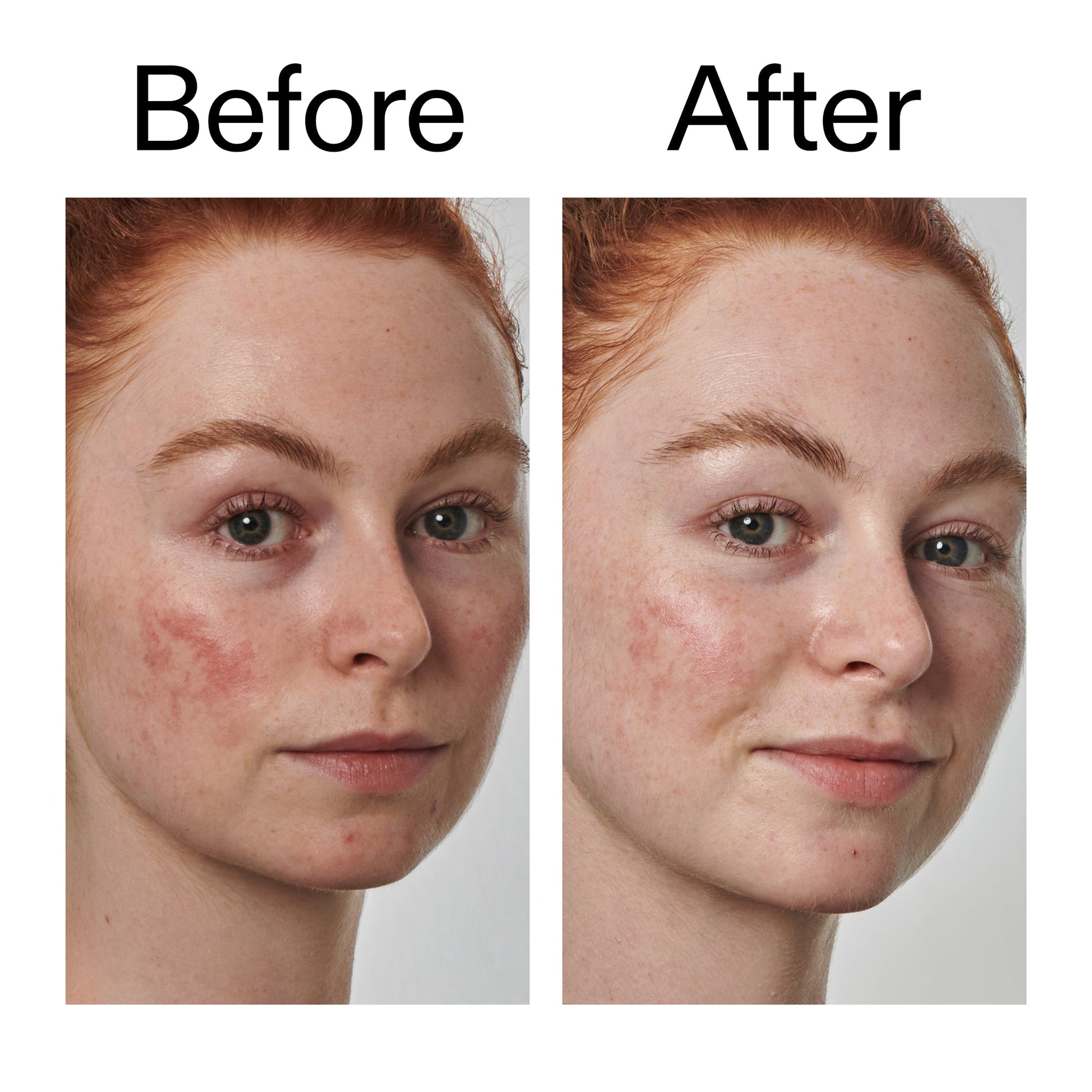 10-azelaic-acid-serum-for-redness-relief-j1 Redness_Relief_Serum_Before_After_2000x2000_3334dc9a-cce9-4e00-8aec-7ad89ca051f2.jpg