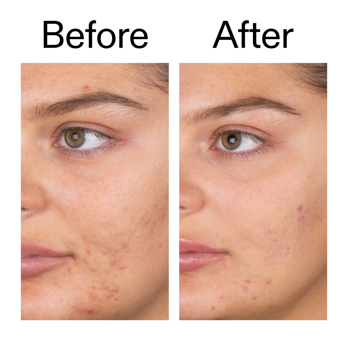 salicylic-acid-cleanser-150ml-k0 Salicylic_Acid_Cleanser_-_150ml_Before_After_2000x2000_e7230494-853f-4b07-82b1-27669104c995.jpg
