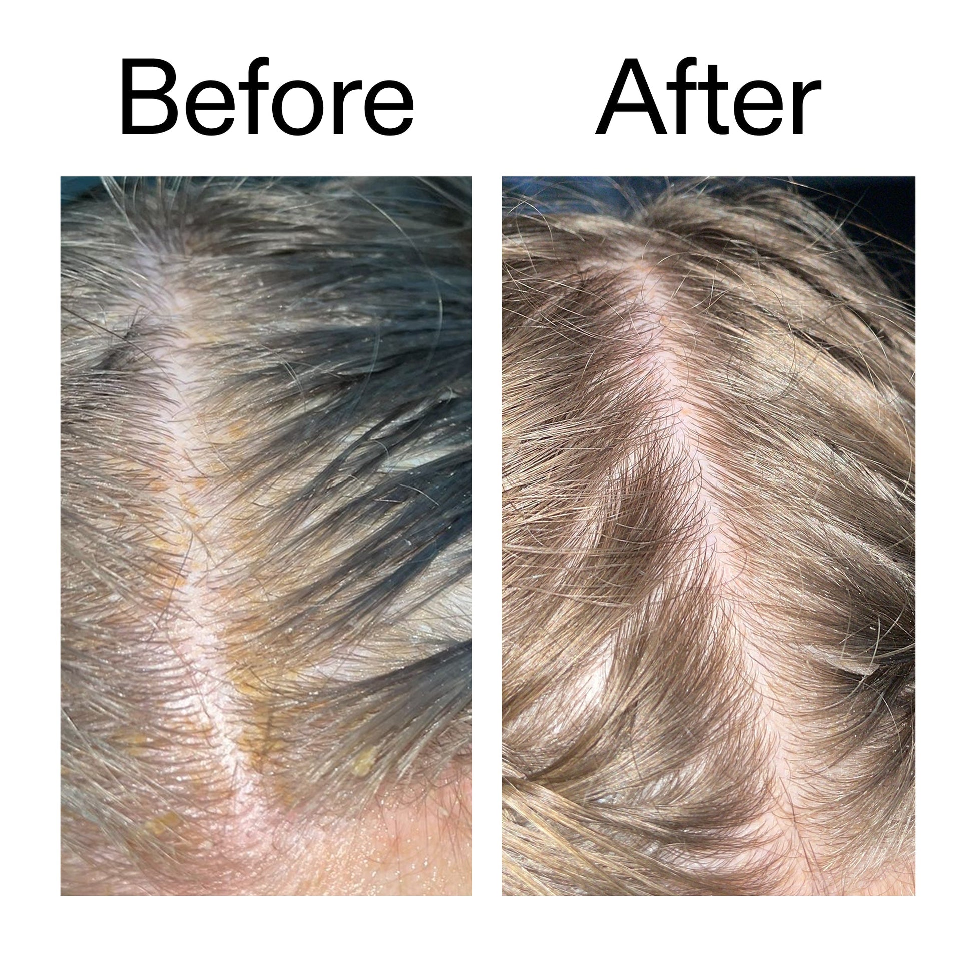salicylic-acid-exfoliating-scalp-treatment-a6 Salicylic_Acid_Exfoliating_Scalp_Treatment_Before_After_2000x2000_e572a30f-057c-4a48-823b-1c09dc97f8d0.jpg