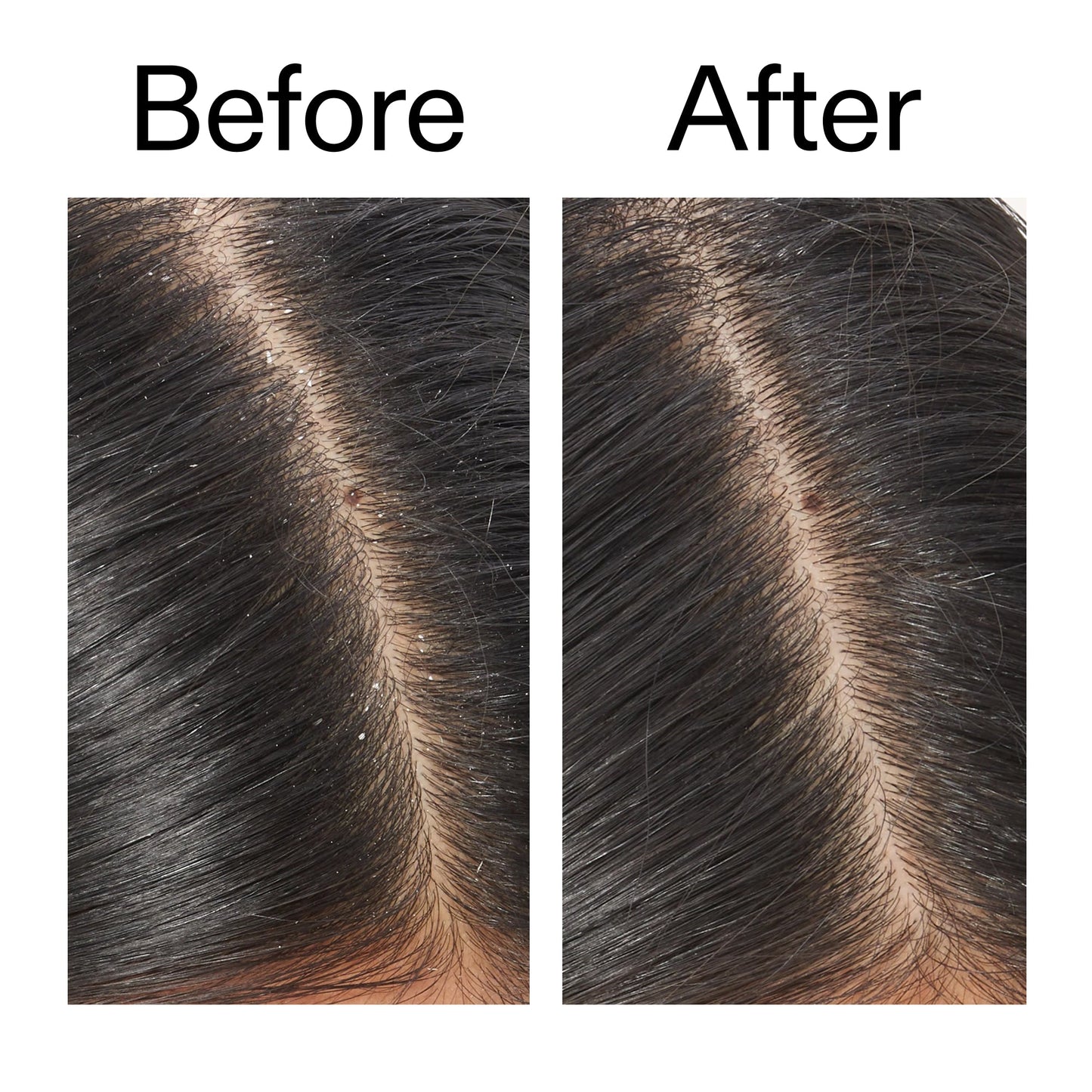 salicylic-acid-exfoliating-scalp-treatment-a6 Salicylic_Acid_Exfoliating_Scalp_Treatment_Before_After_V2_2000x2000_02bd61ad-42bf-490b-b3e3-7e04b2e8a673.jpg