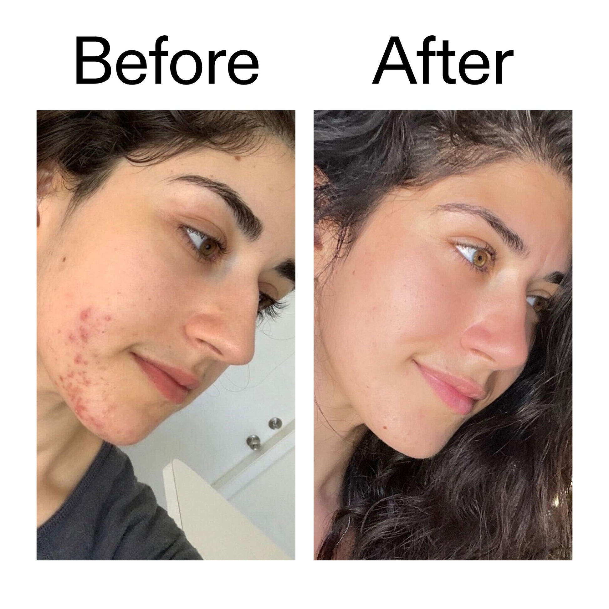 succinic-acid-acne-treatment-d0 Succinic_Acid_Treatment_Before_After_2000x2000_6a5f0054-2f58-4433-9314-0dc72c9bdd3b.jpg