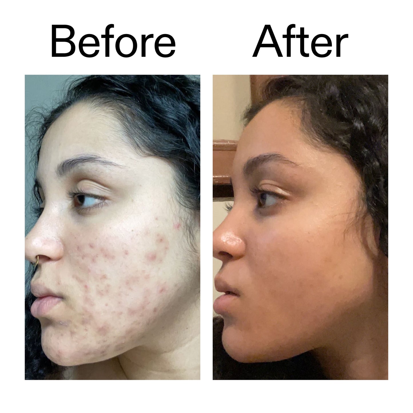 tranexamic-acid-serum-z3 Tranexamic_Acid_Serum_Before_After_2000x2000_98ebc8be-77b0-4843-8a22-90790ebe918b.jpg